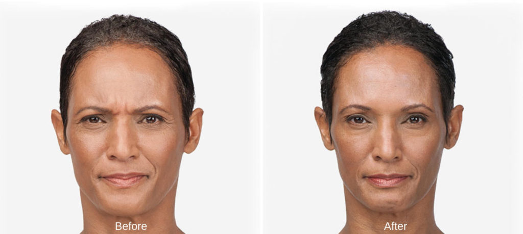 Botox Before & After - Teaneck, NJ