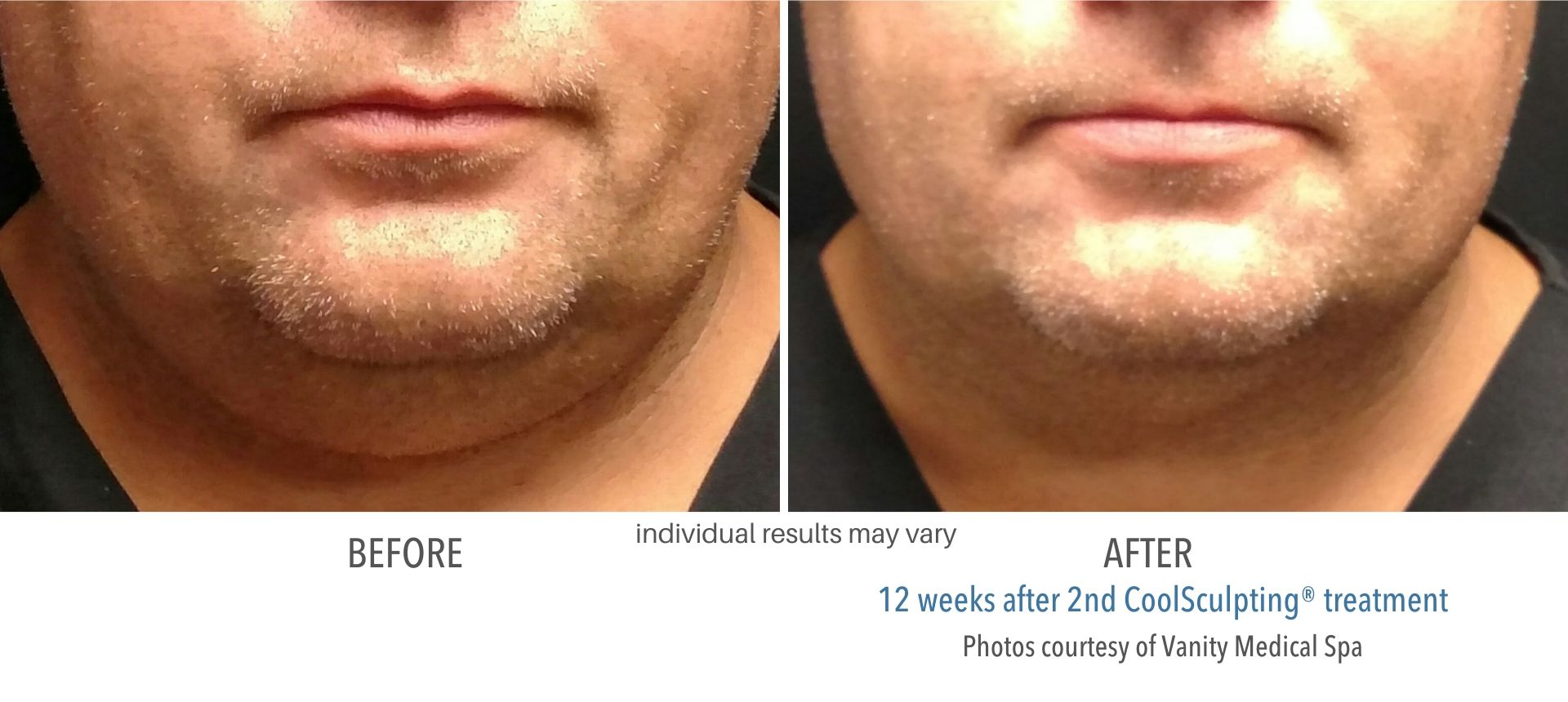 Coolsculpting Before And After 1