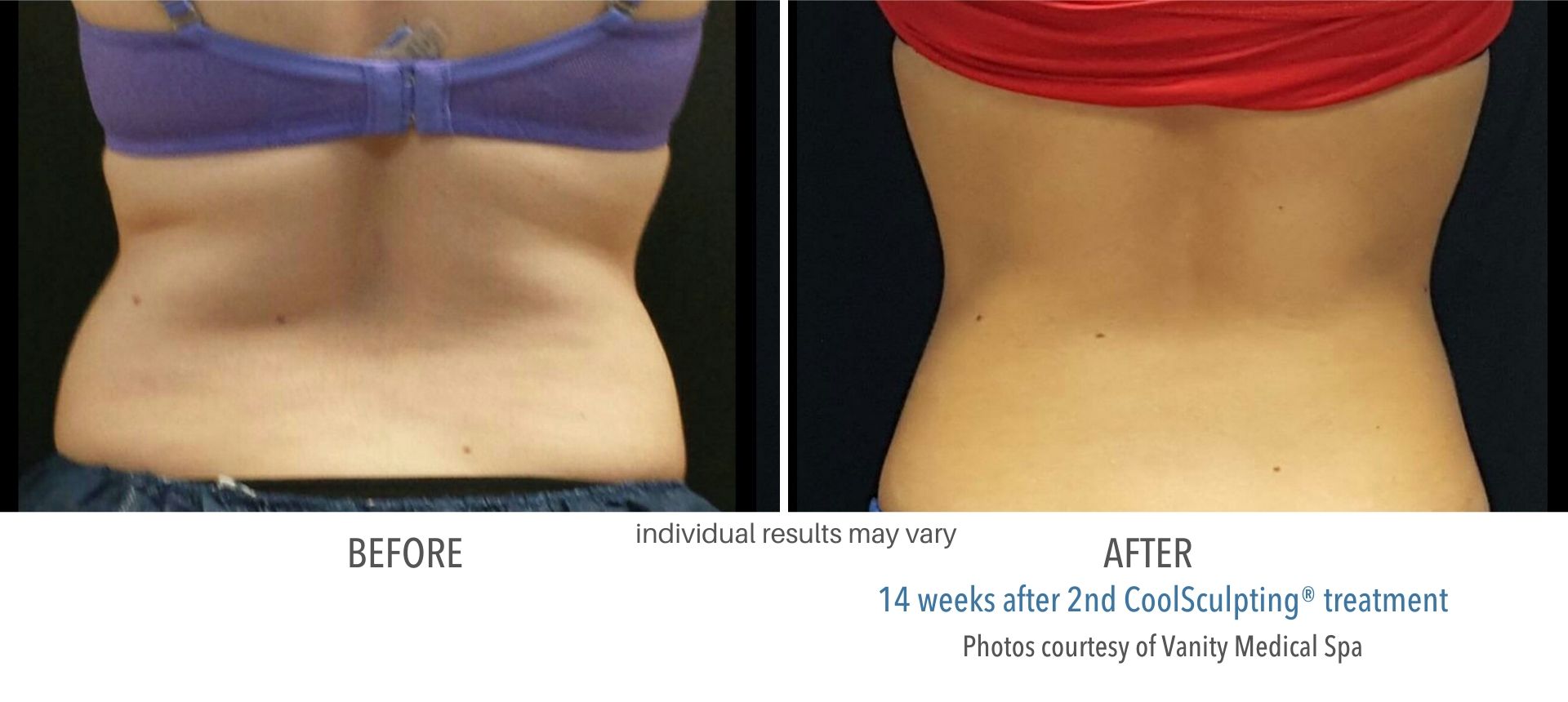 Coolsculpting Before And After 4