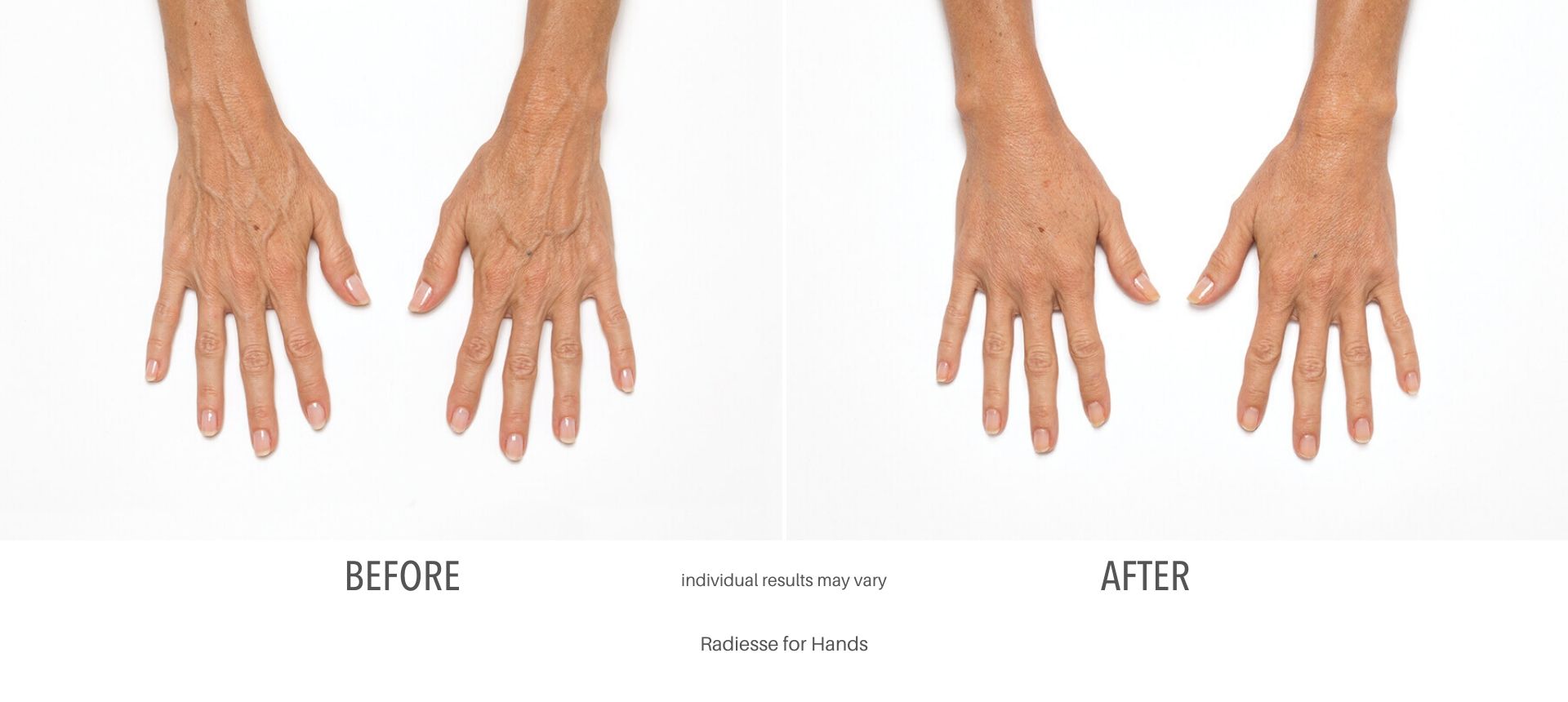 Radiesse For Hands Before & After - Teaneck, NJ