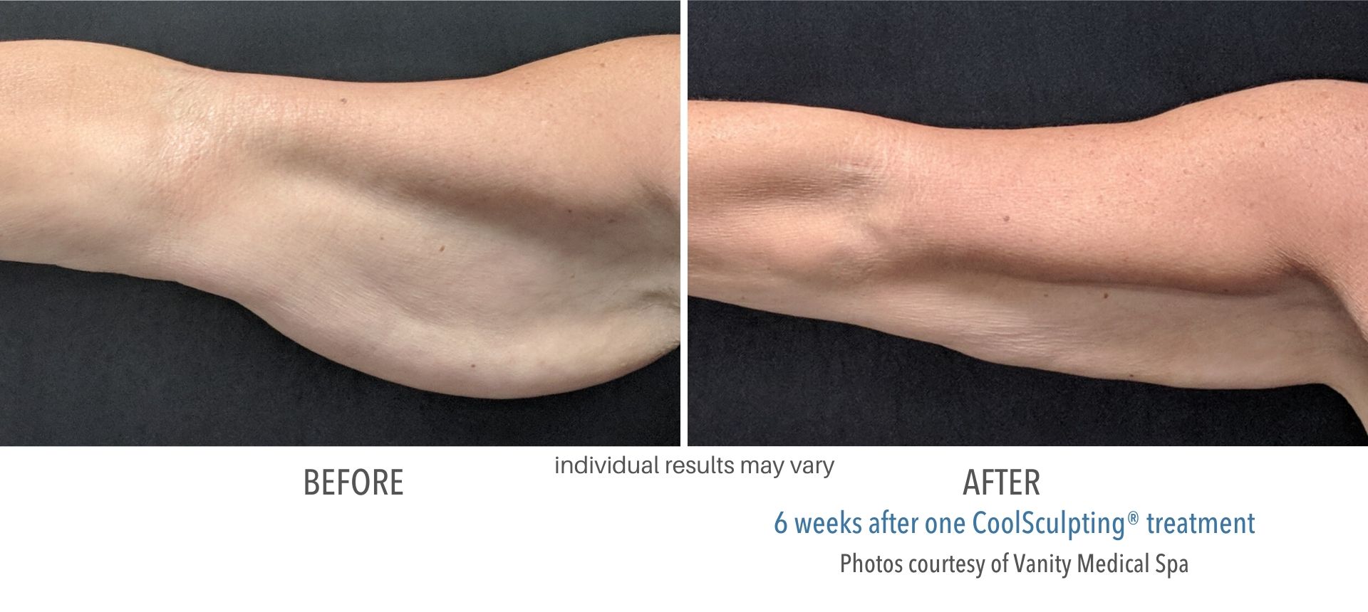 Coolsculpting Before And After 6
