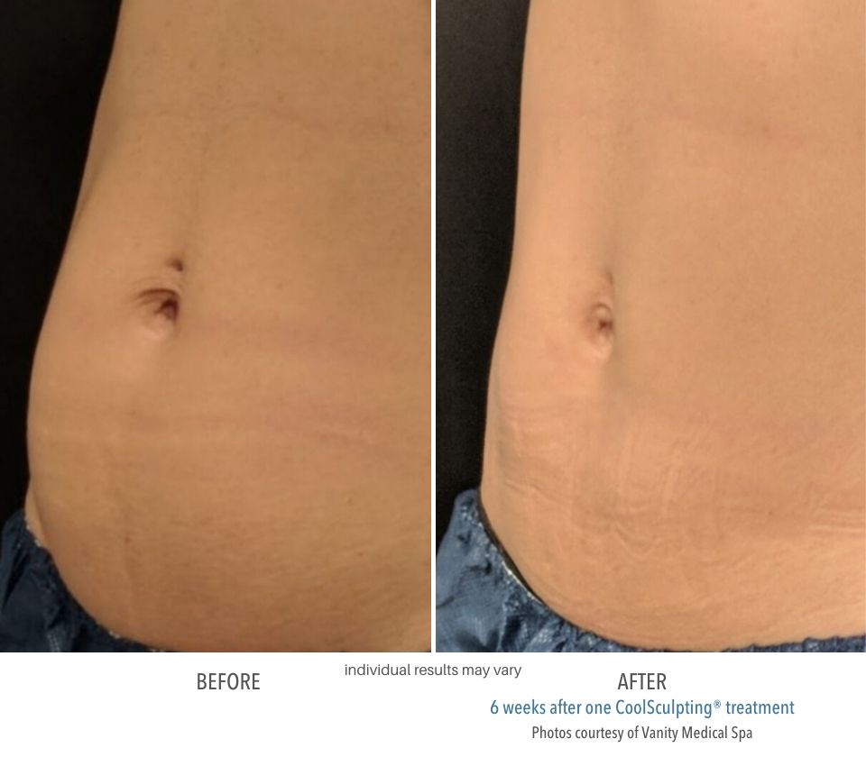 Coolsculpting Before And After 7