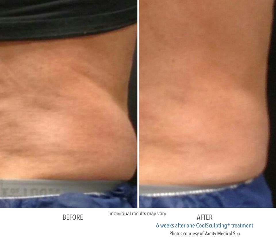 Coolsculpting Before And After 8