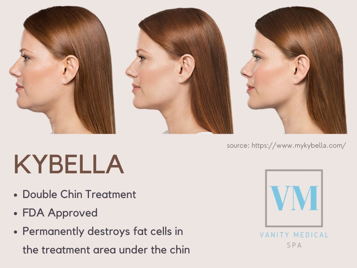 Kybella for double chin - Teaneck, NJ