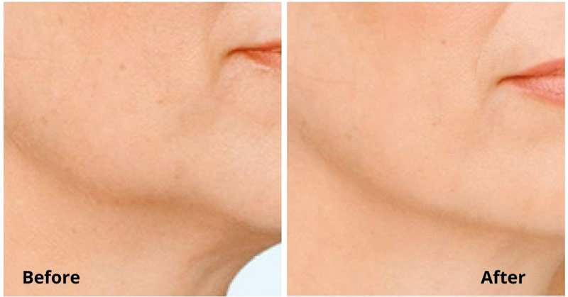Laser Skin Tightening Before & After