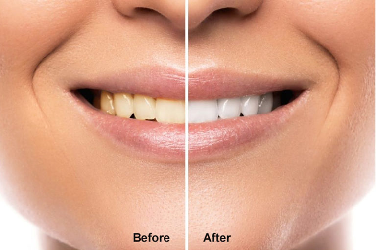 Laser Teeth Whitening Before and After