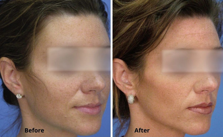 Micro Laser Peel Before & After