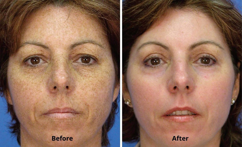 Micro Laser Peel Before & After
