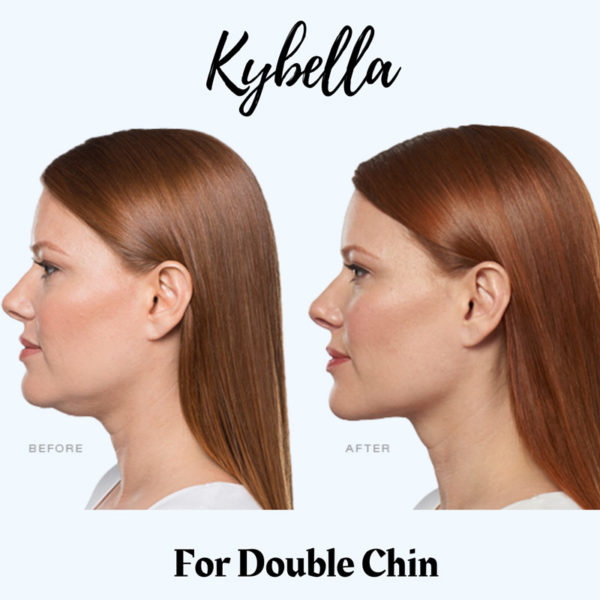 Kybella for Double Chin