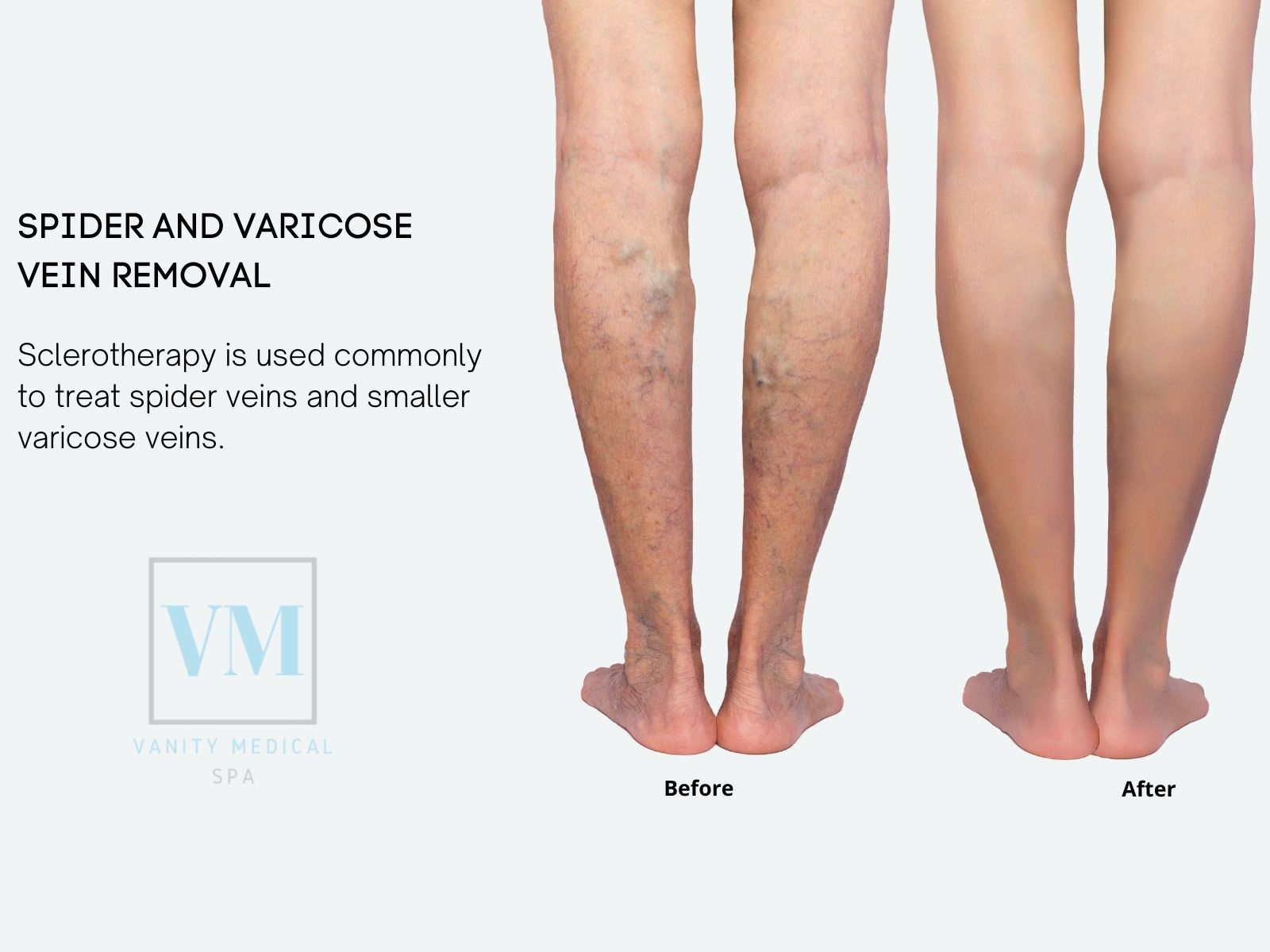 Spider and Varicose Vein Removal