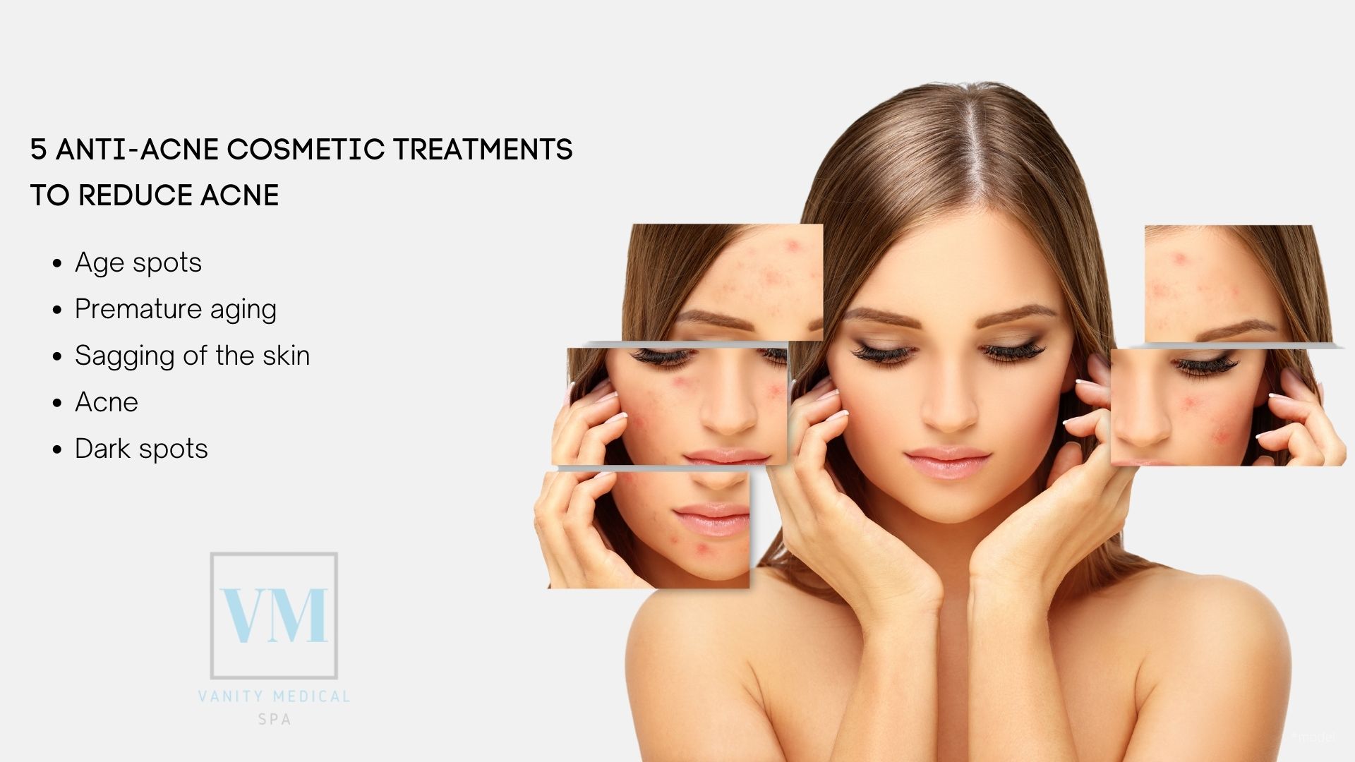 5 Anti-Acne Cosmetic Treatments to Reduce Acne - Vanity Medical Spa