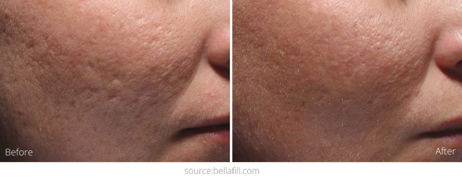 Bellafill for Acne Scars