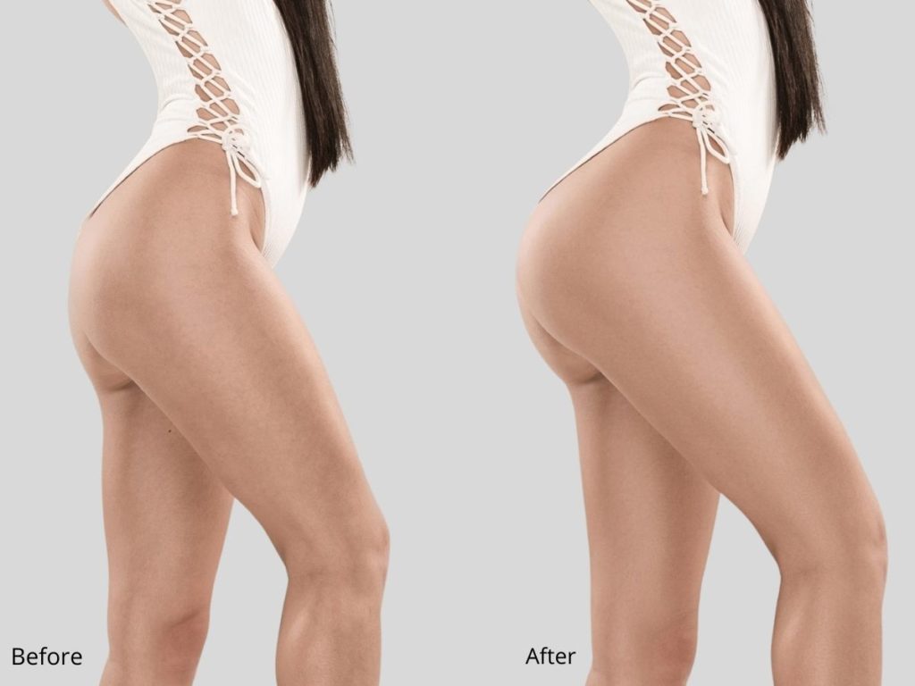 Sculptra Butt Lift before and after