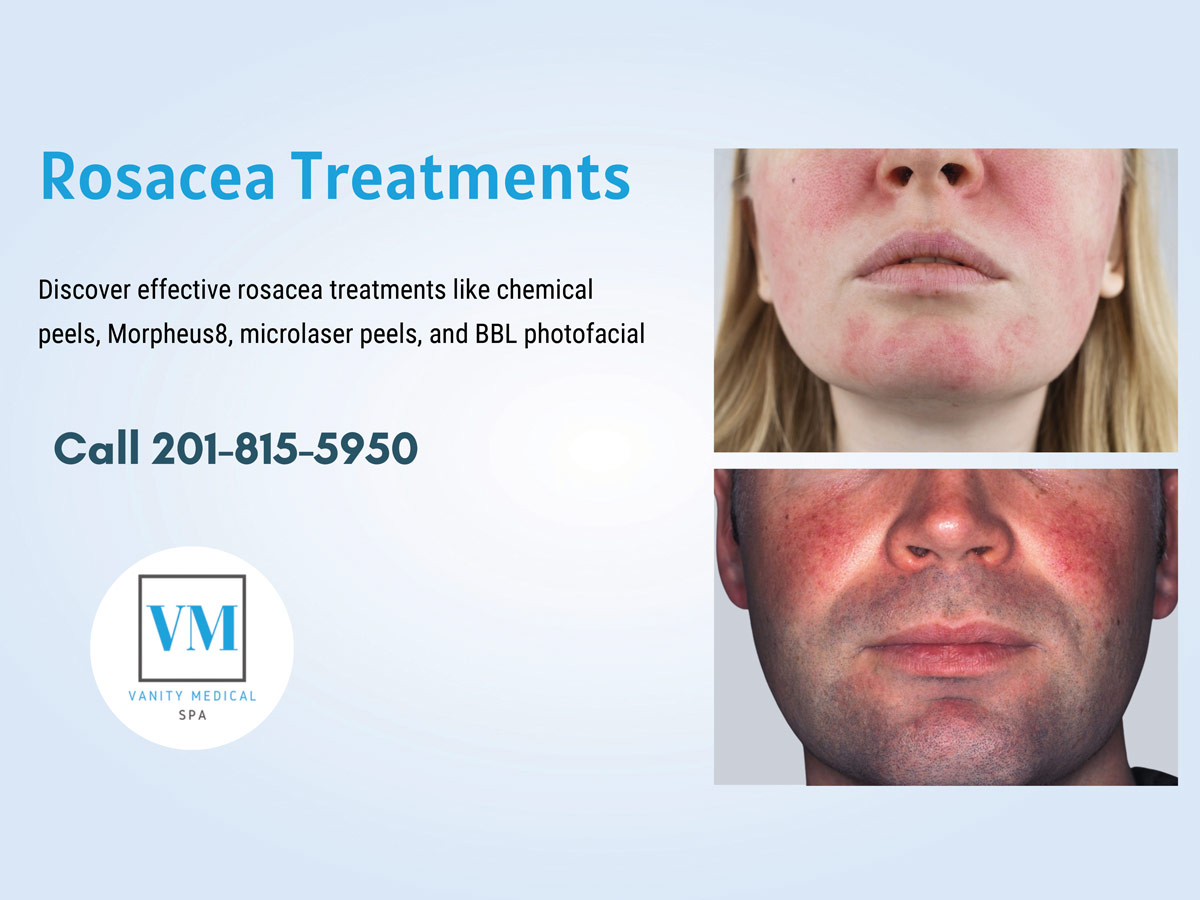 Rosacea Treatments in Bergen County. Call Vanity Medical Spa