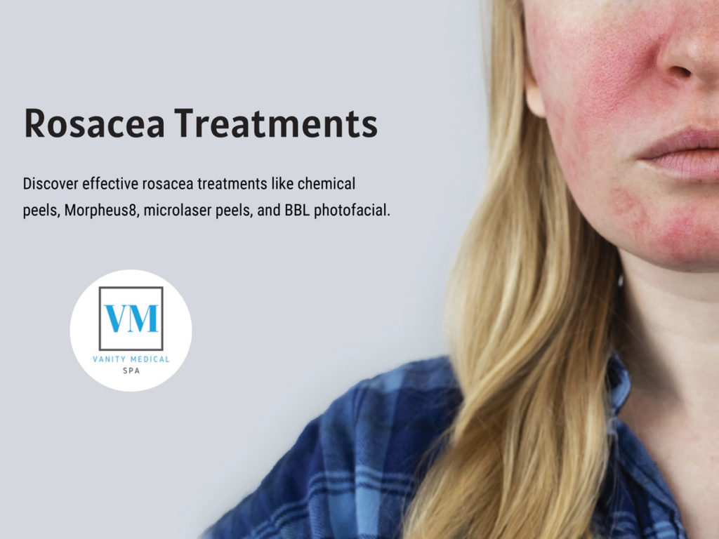 Rosacea Treatments in Bergen County