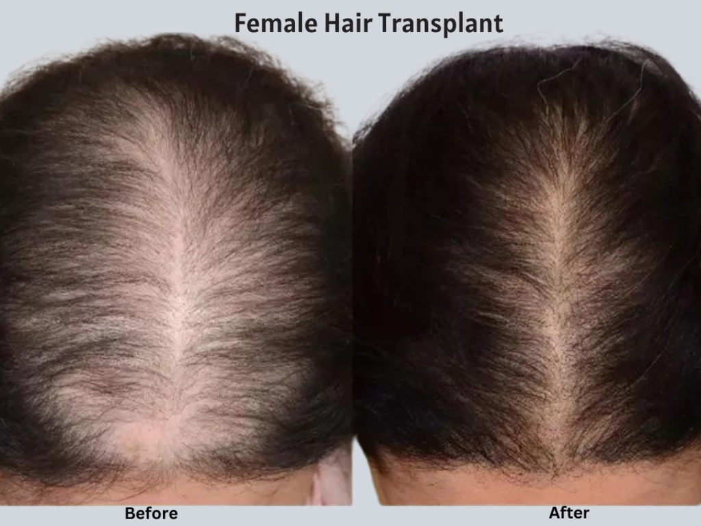 Female Hair Transplant in Bergen County, NJ