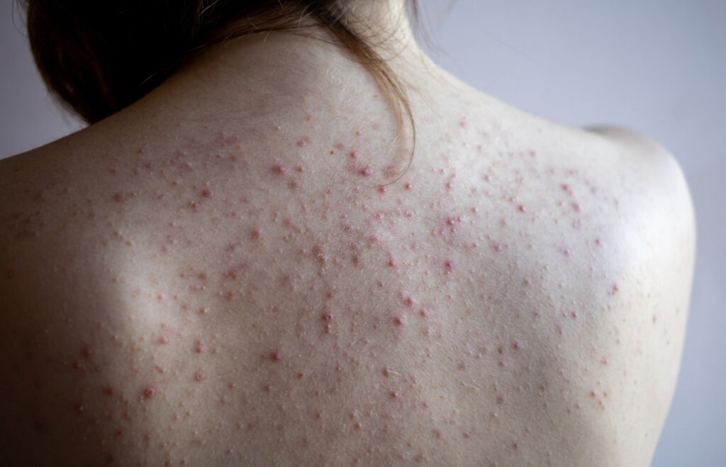 Bacne Treatments in Paramus, NJ
