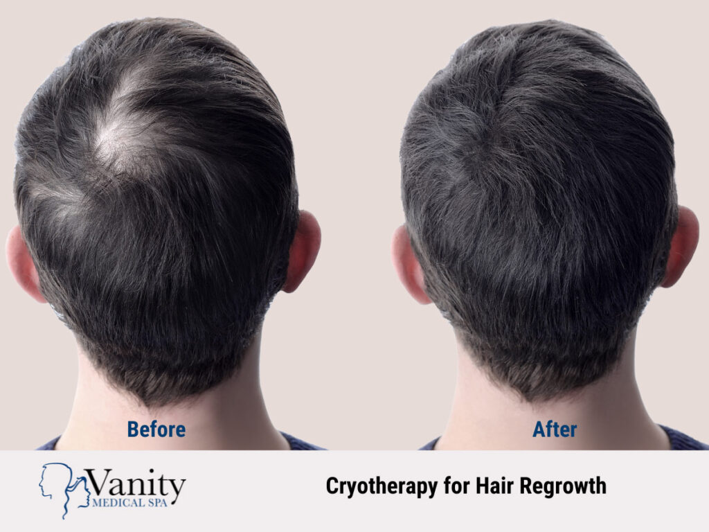 Cryotherapy for hair growth, before and after