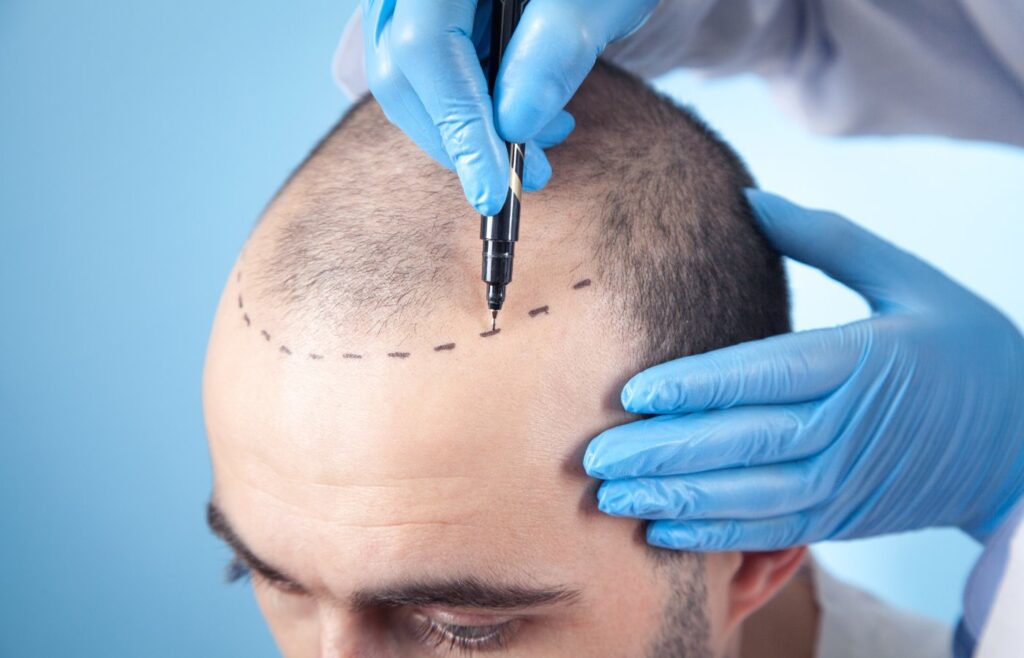 Fue Hair Transplant Paramus, NJ