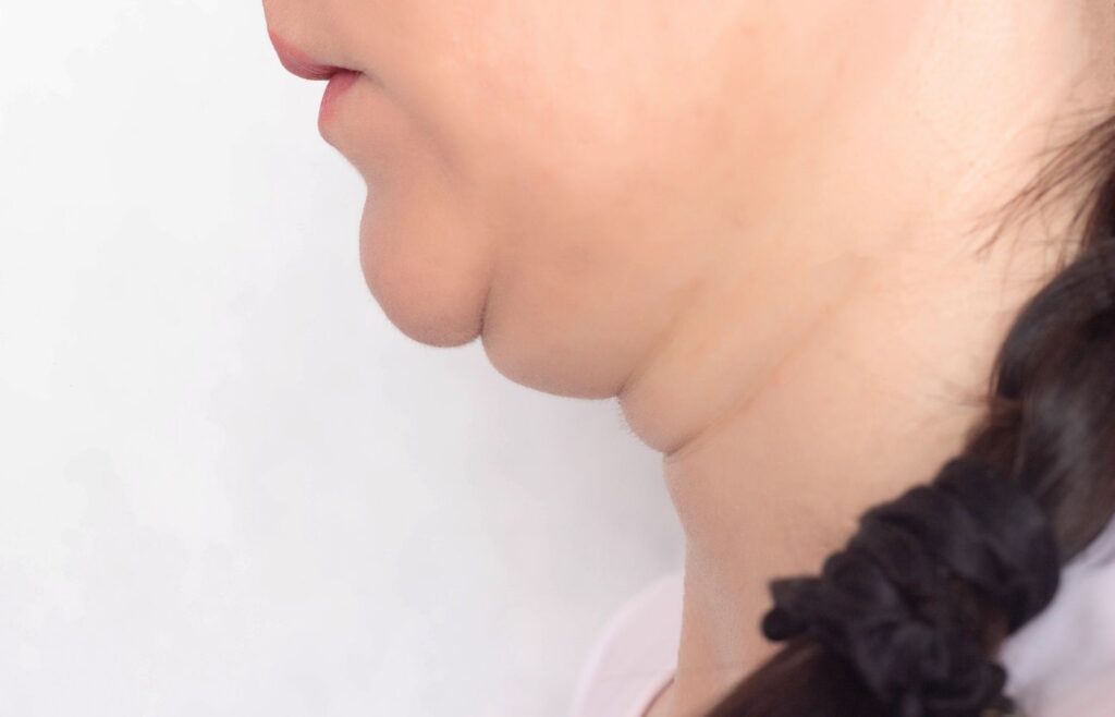 Kybella Double Chin Treatment in Paramus, NJ