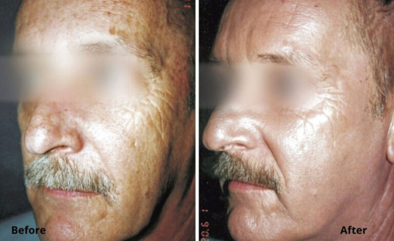 micro-laser-peel-for-face-before-after-1.jpg
