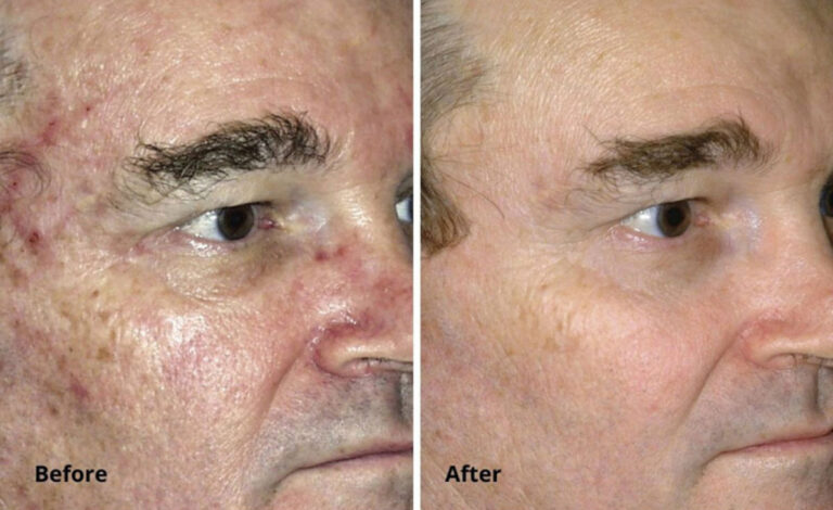 micro-laser-peel-for-face-before-after-2.jpg