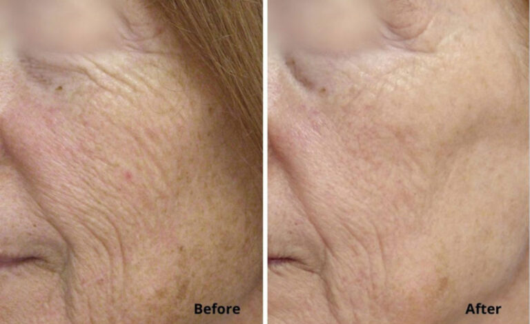 micro-laser-peel-for-face-before-after-3.jpg