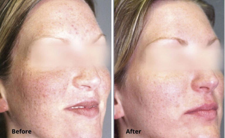 micro-laser-peel-for-face-before-after-5.jpg