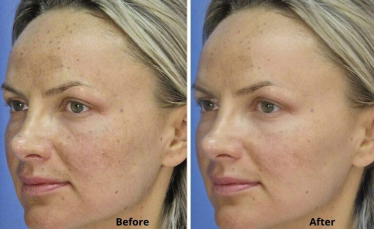 micro-laser-peel-for-face-before-after-6.jpg