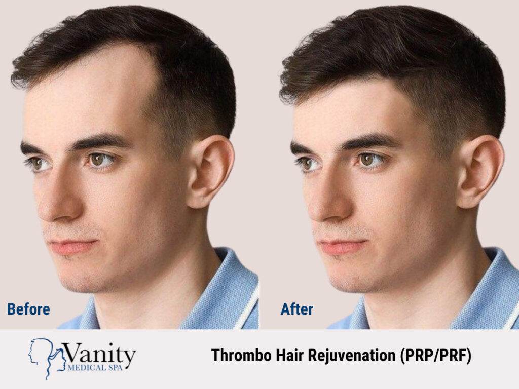 Thrombo Hair Rejuvenation (PRP/PRF) before and after