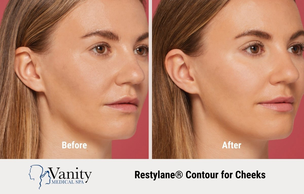 restylane-contour-treatment-for-cheeks.jpg