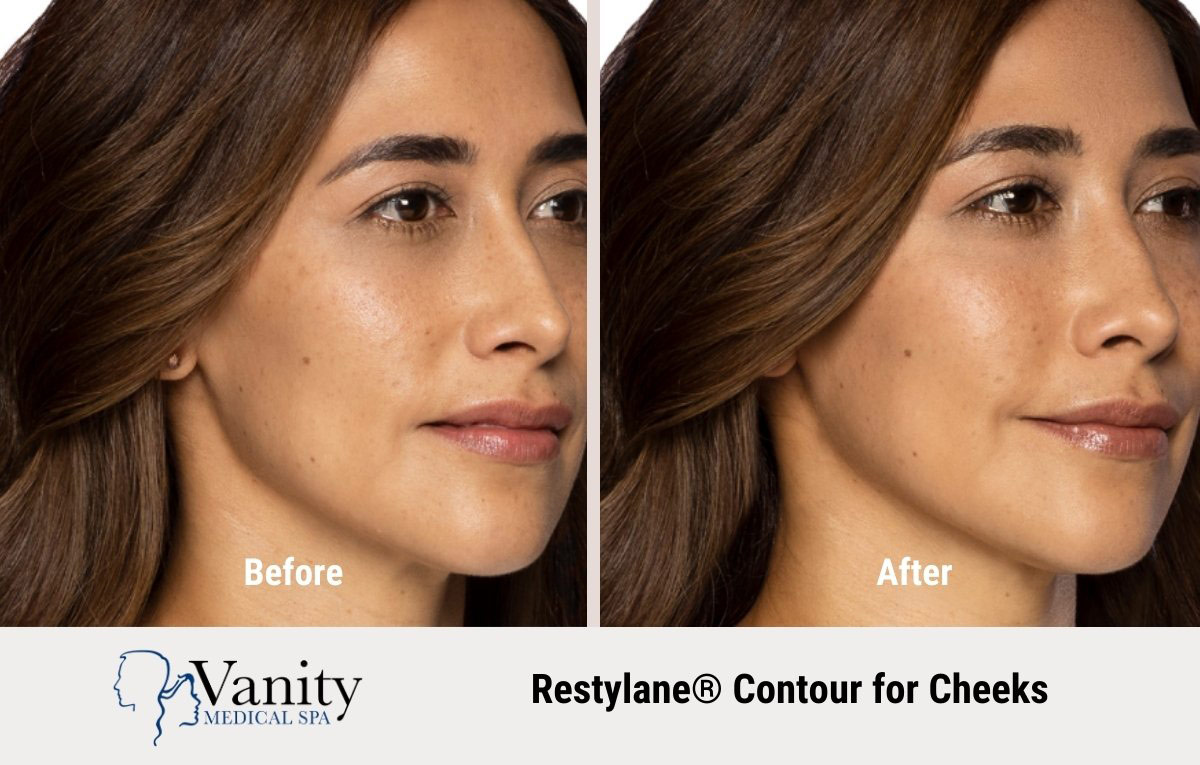restylane-contour-treatment-for-cheeks-2.jpg
