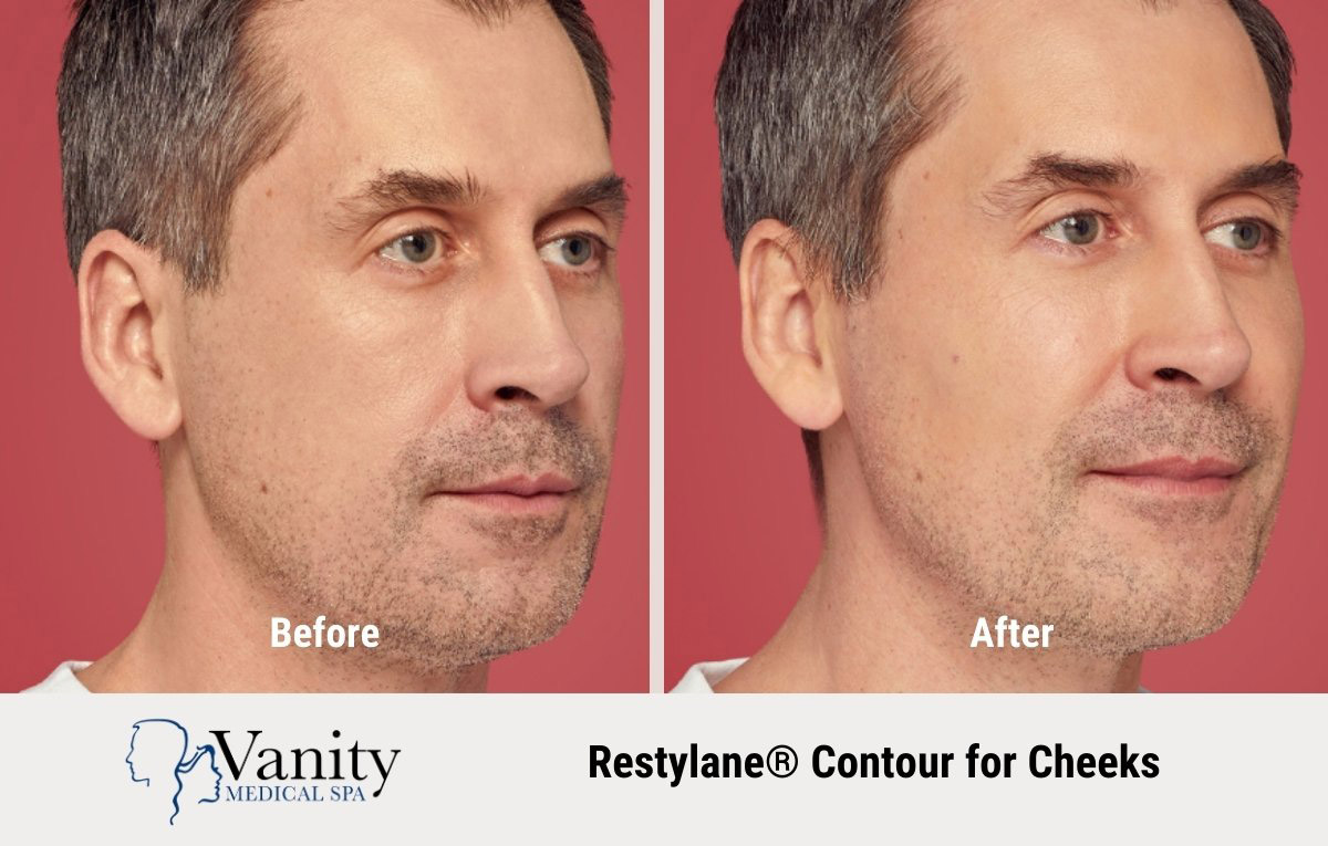 restylane-contour-treatment-for-cheeks-3.jpg