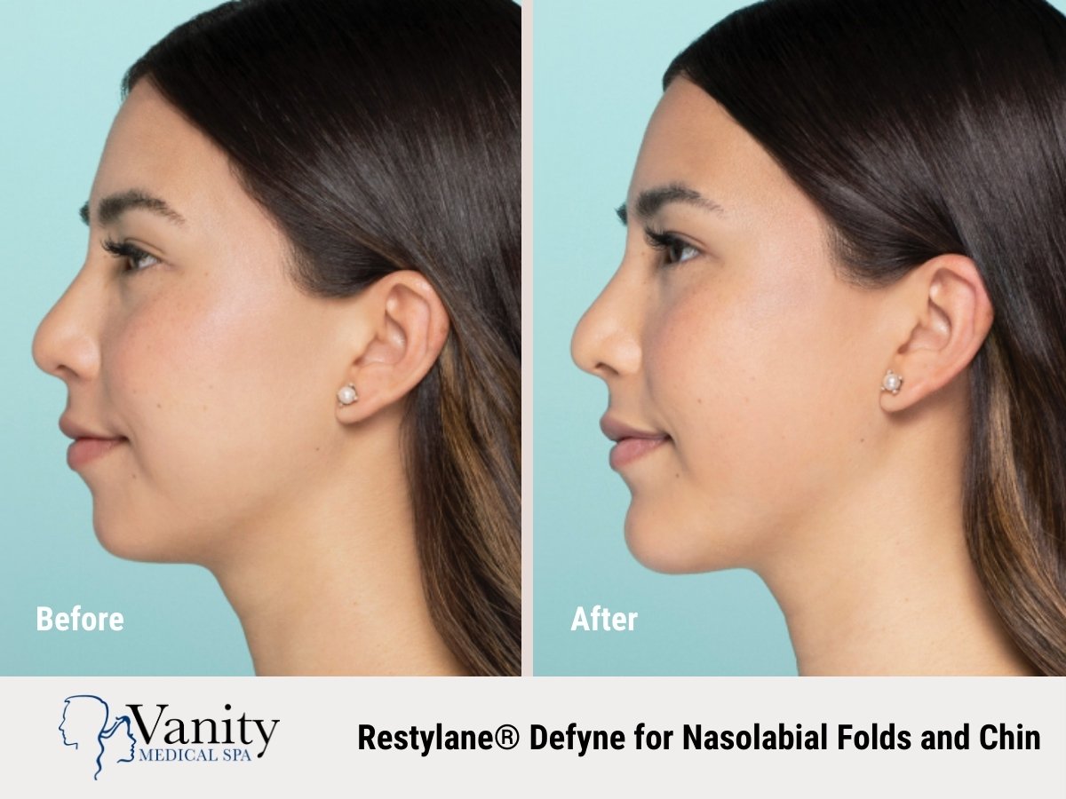 restylane-defyne-treatment-for-chin-2-1.jpg