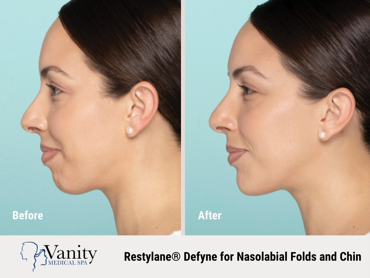 restylane-defyne-treatment-for-chin-3-1.jpg