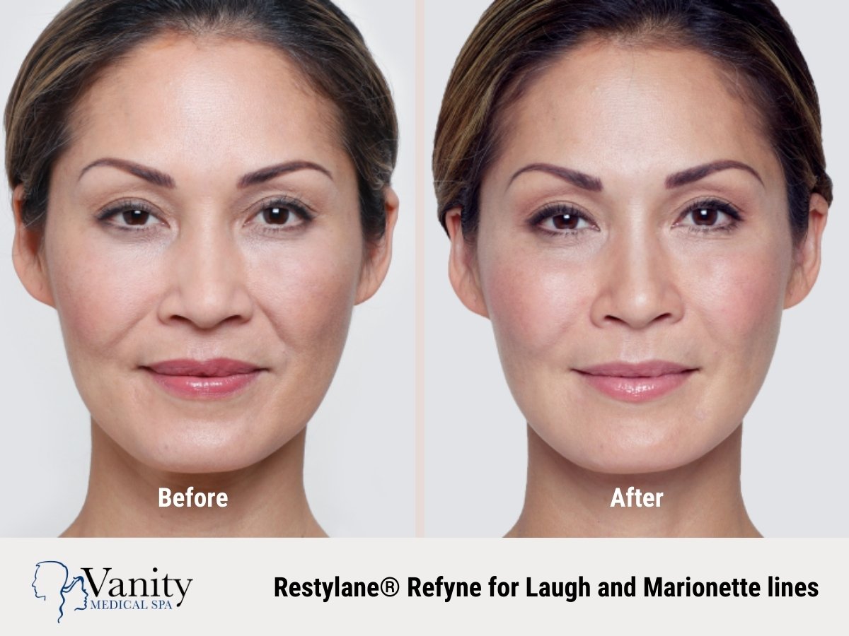 restylane-refyne-treatment-for-marionette-lines.jpg