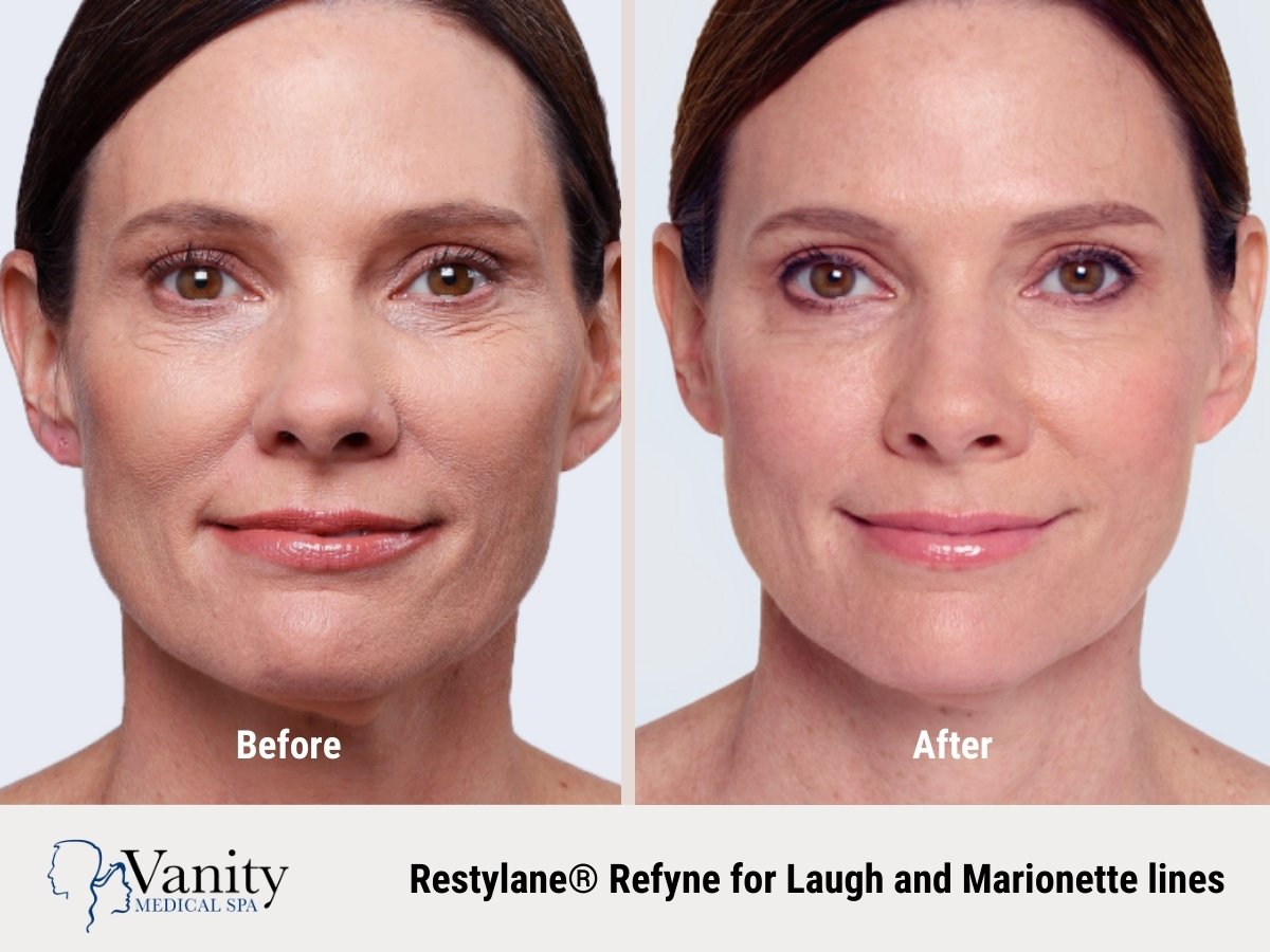 restylane-refyne-treatment-for-marionette-lines-2.jpg