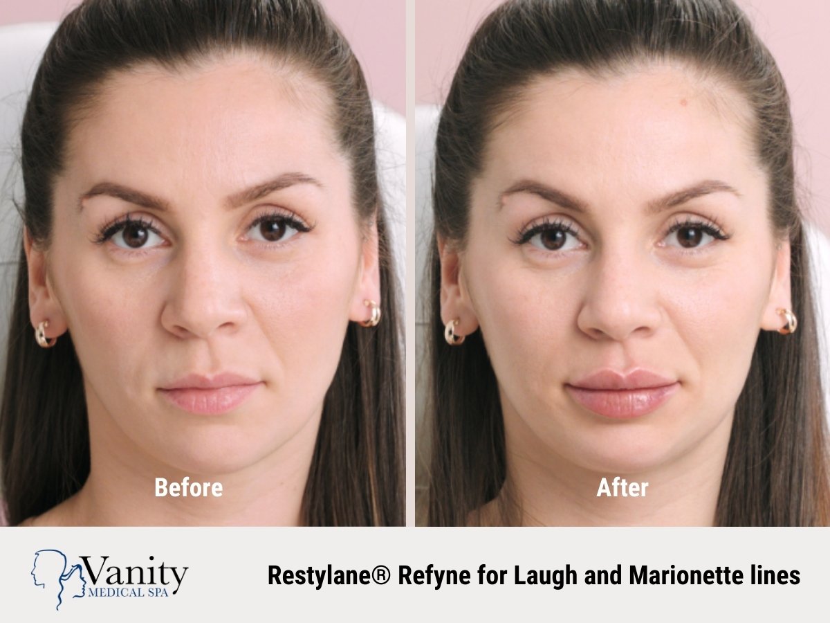 restylane-refyne-treatment-for-marionette-lines-3.jpg
