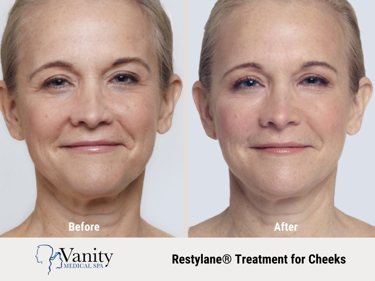 restylane-treatment-for-cheeks.jpg
