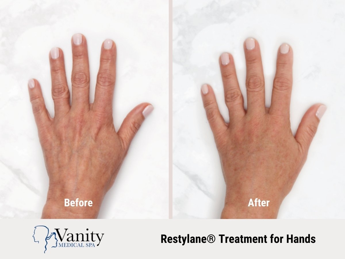 restylane-treatment-for-hands.jpg