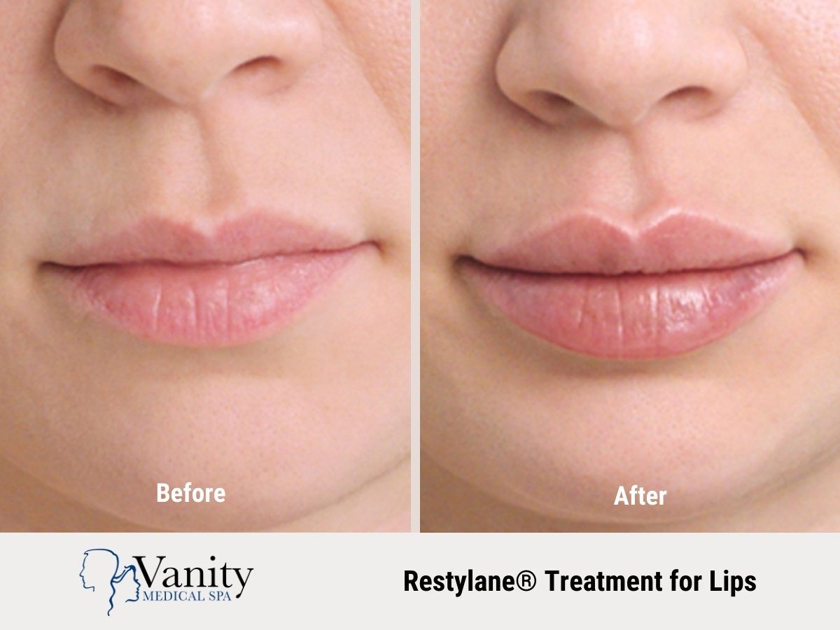 restylane-treatment-for-lips.jpg