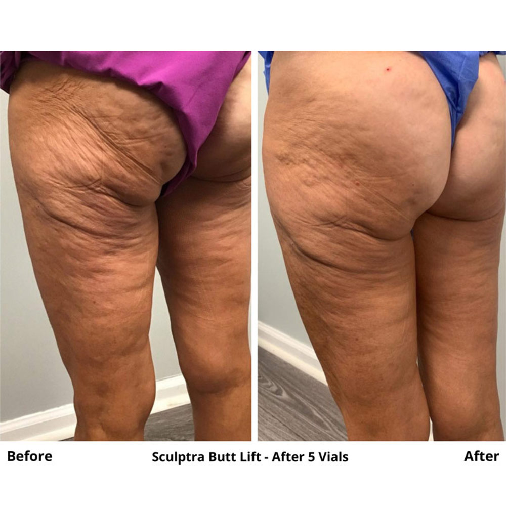 sculptra-butt-lift-in-bergen-county-2.jpg