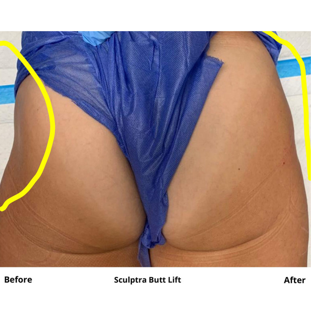 sculptra-butt-lift-in-bergen-county-3.jpg