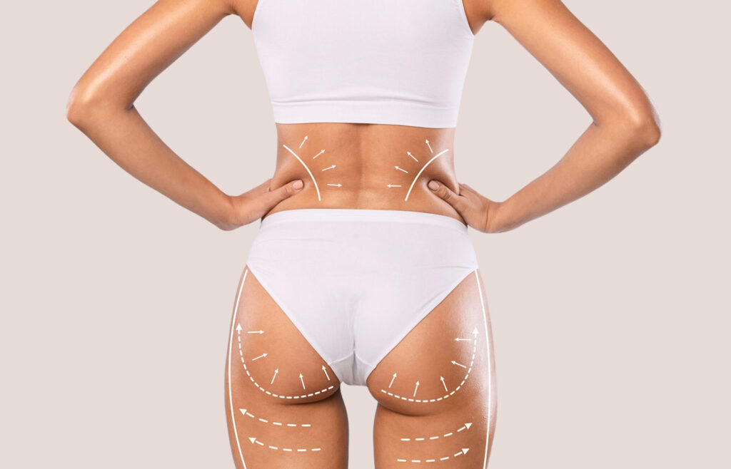 Sculptra Butt Lift is the most popular option to get a fuller looking butt without undergoing surgery