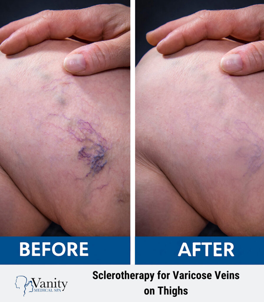 varicose-veins-on-thighs-before-after-1.jpg
