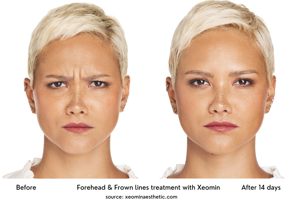 Xemoin treatment for forehead lines, crow’s feet, and frown lines before and after