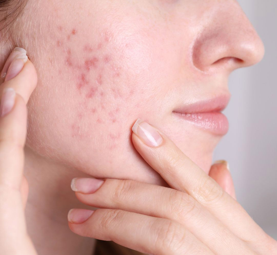 Acne Awareness Month at Vanity Medical Spa