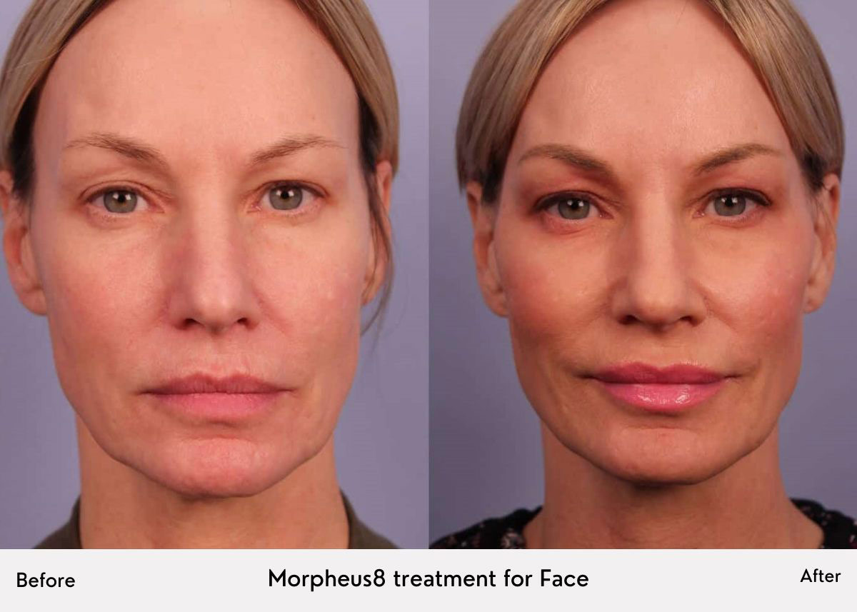 Morpheus8 for Face: Before and After