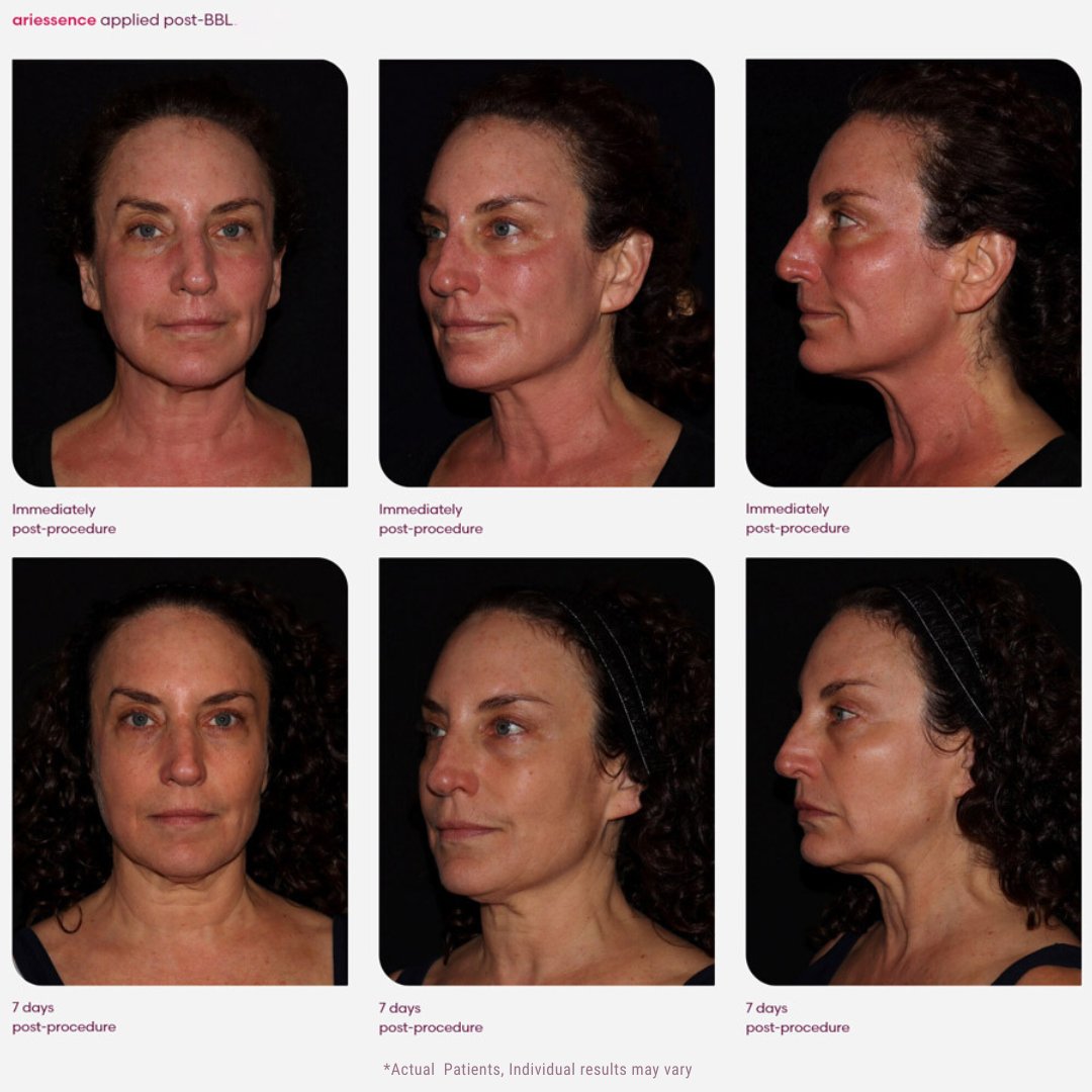 See the Power of Nature: Ariessence cuts post-procedure downtime in half.