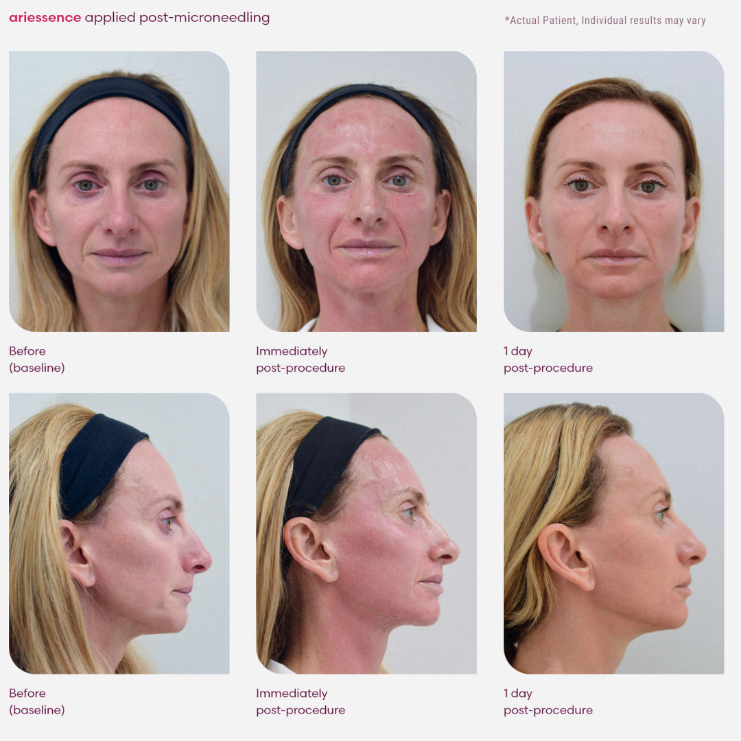 See the Power of Nature: Ariessence cuts post-procedure downtime in half.